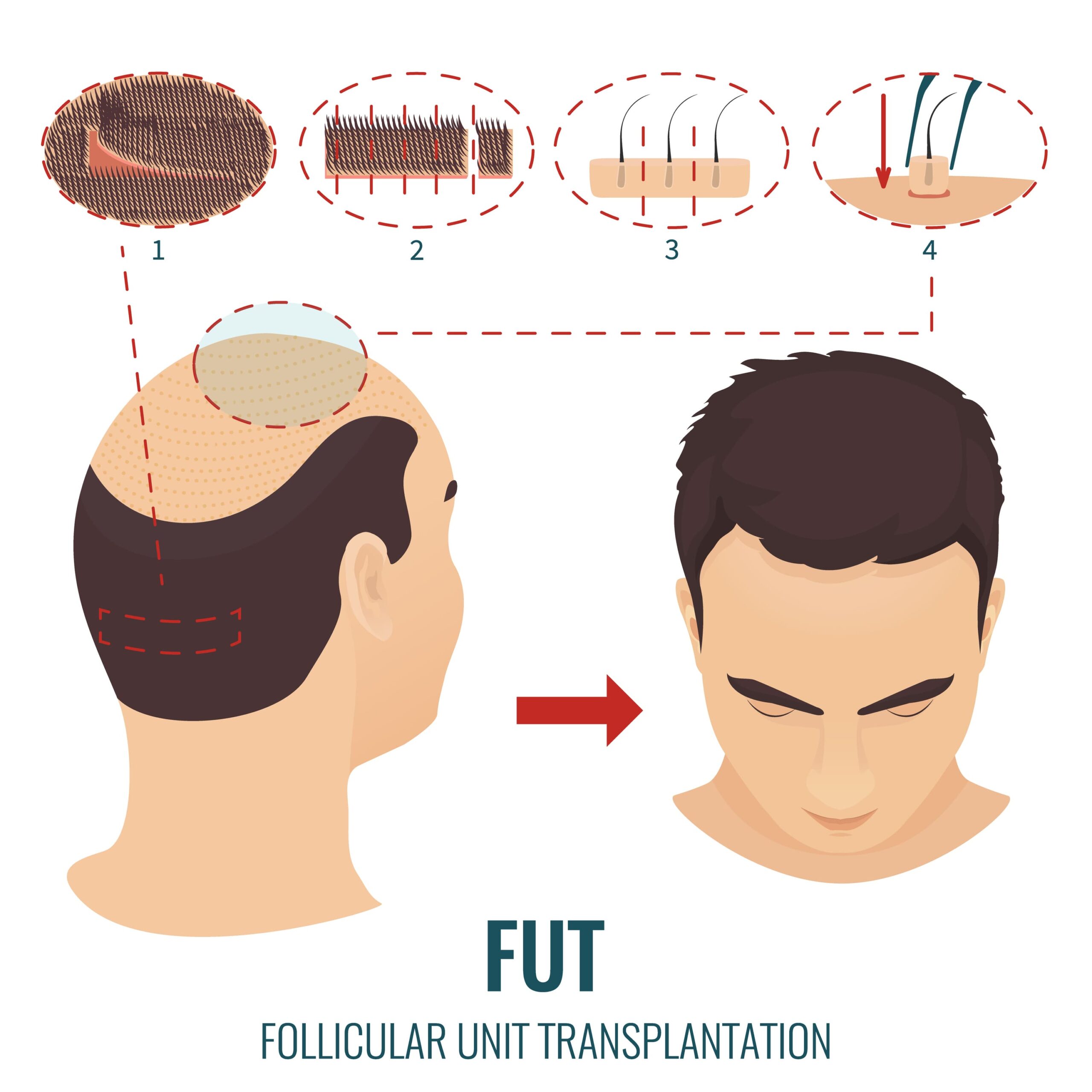 FUT Hair Transplantation – Everything You Should Know (1)